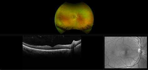 Vitreous Floaters Case Study