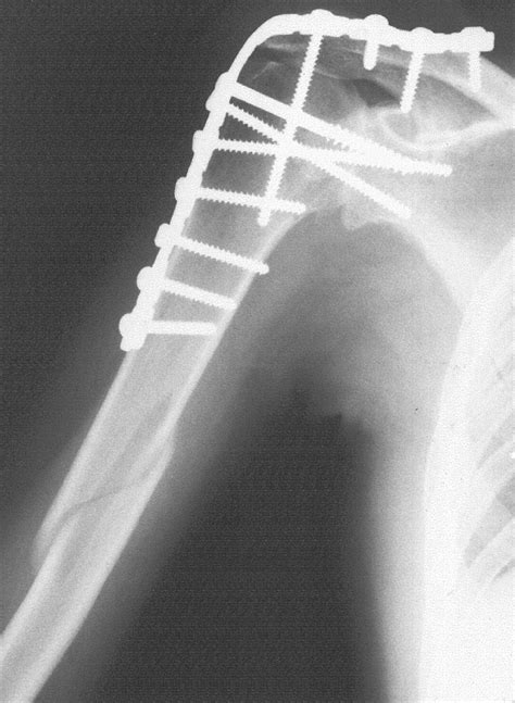 Shoulder Arthrodesis Indications Technique Results And