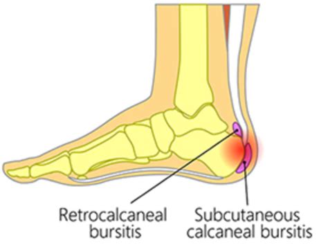 Bursitis Of The Foot And Ankle