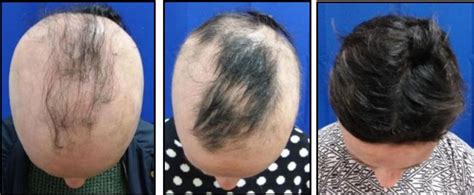 Experimental Pill Prompts Some To Regrow A Nearly Full Head Of Hair The Boston Globe