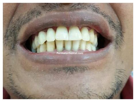 Harga satu gigi palsu bisa mencapai jutaan, belum lagi masih ada biaya konsultasi dan. Ahli Gigi Bali | Permata Dental: GIGI PALSU LEPASAN ATAU ...