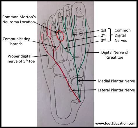 Mortons Neuroma Footeducation