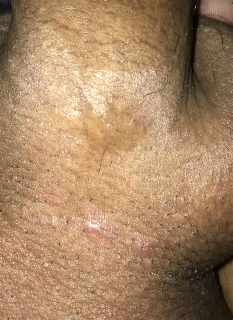 Herpes simplex is a viral infection caused by the herpes simplex virus. Pimple or herpes ? How to tell difference ??? | Genital ...