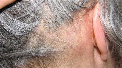 Crusty Behind Ears Causes Symptoms Dry Skin Psoriasis Skin