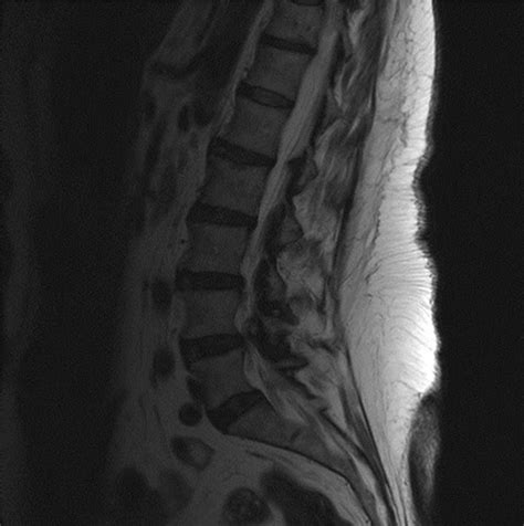 Presentation Of A Rare Case Of Bilateral Lumbar Synovial Cysts