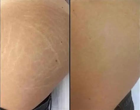 Laser Stretch Mark Treatment And Removal