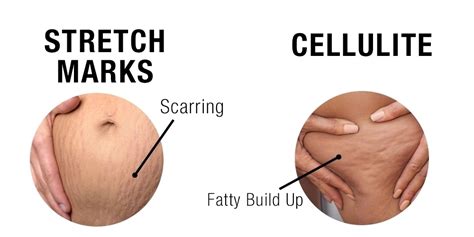 Stretch Marks And Cellulite Invigorate Advanced Aesthetics