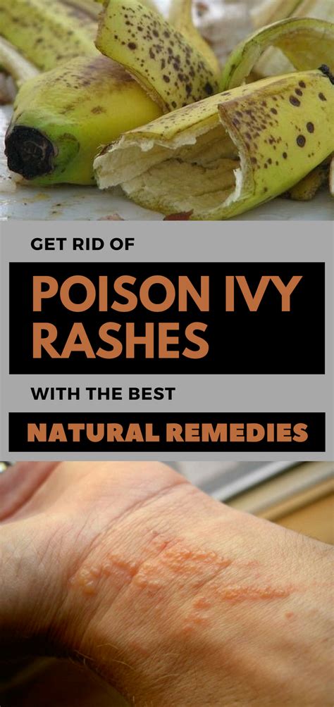 Get Rid Of Poison Ivy Rashes With The Best Natural Remedies Poison Ivy Rash Natural Remedies