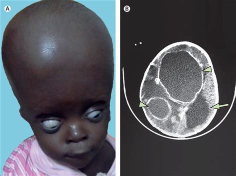 Remarkable Recovery In An Infant With Brain Abscesses The Lancet