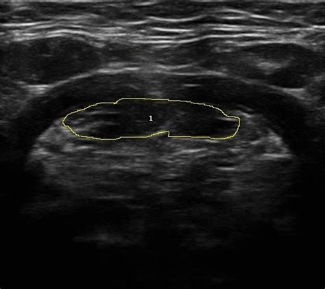 B Mode Ultrasound Image Of The Submental Muscles Cross Sectional Area