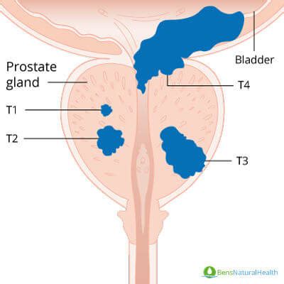 If you are diagnosed with prostate cancer, you may need to undergo further testing to determine whether it has metasticized (spread) beyond your prostate to other parts of your body. Prostate Cancer Stages Explained - Ben's Natural Health