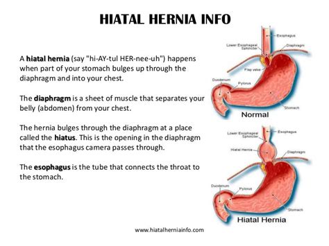 Hiatal Hernia Info