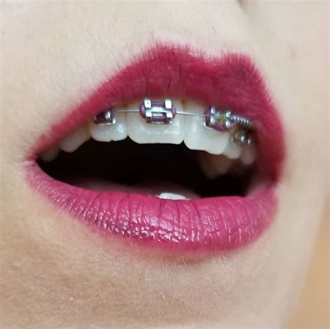 10 good reasons to choose purple braces braces explained