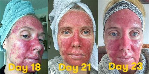 These Graphic Photos Of Skin Precancer Treatment Are A Must See Self
