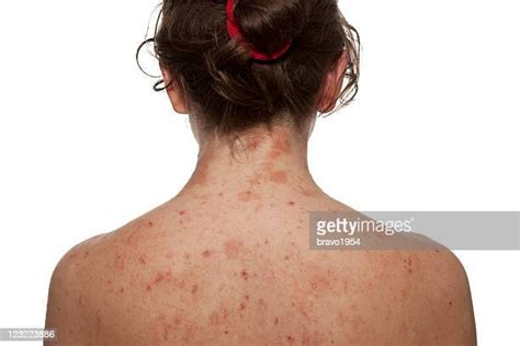 Dermatitis Back Photos And Premium High Res Pictures Getty Images