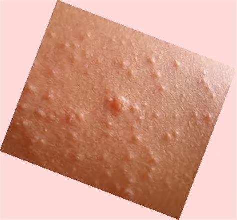 Bumps On Skin Dorothee Padraig South West Skin Health Care