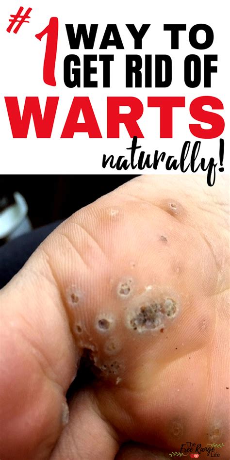 The One Thing To Do For Get Rid Of Warts Warts Get Rid Of Warts