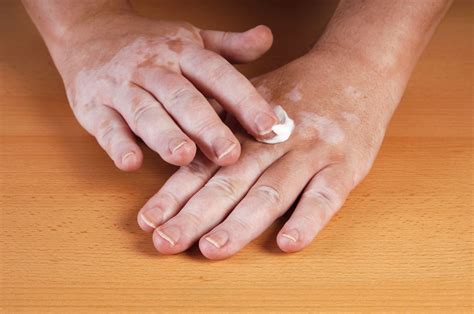 Vitiligo Or Leucoderma Natural Treatment Ayurvedic Cure