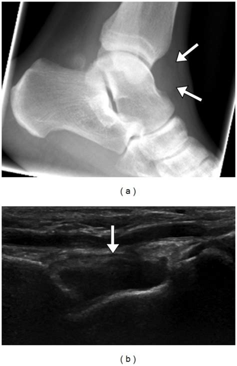 Tibiotalar Gout With Ankle Effusion Lateral Ankle Radi Open I
