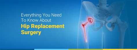 Everything You Need To Know About Hip Replacement Surgery Zoi Hospitals