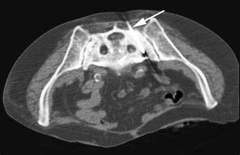 Percutaneous Sacroplasty For The Treatment Of Sacral Insufficiency