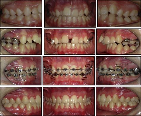 Clinical Photographs Of Orthodontic Treatment From Pretreatment To