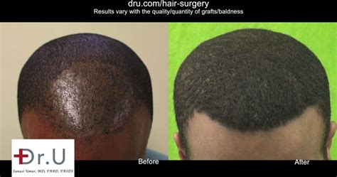 Black afro hair transplants (ie. DrUPunch Curl, Best Tool For FUE Hair Transplant for Black ...