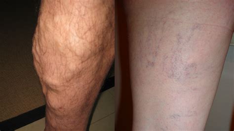 The Difference Between Spider And Varicose Veins Baywood Clinic