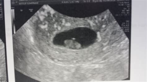 Missed Miscarriage At 9 Weeks Babycenter