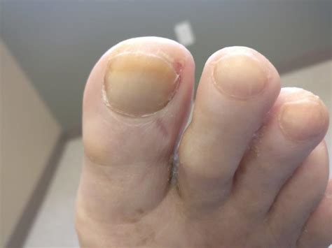 Toe Nail Coming Off The Nail Bed Causes Remedies And Best Treatment
