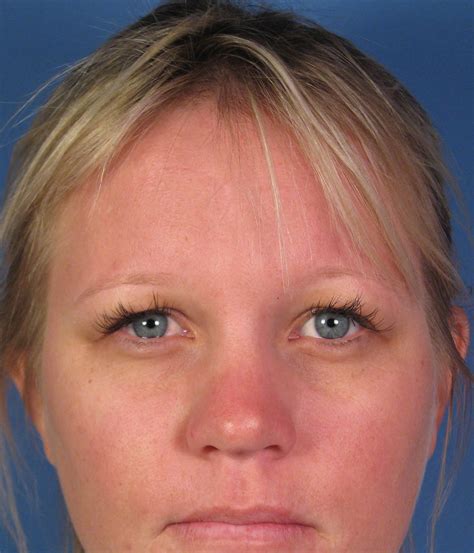 San Diego Ca Facial Scar Revision Reconstruction By Dr John Hilinski