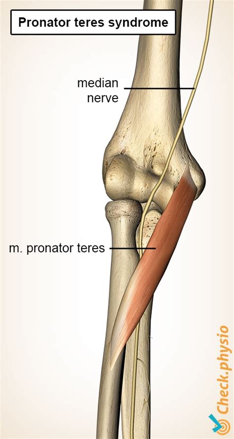Pronator Teres Syndrome Physio Check
