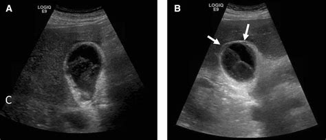 66 Year Old Man With Colorectal Cancer Treated With Bevacizumab With