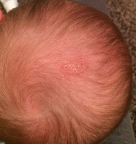My 8 Month Old Daughter Just Developed This Sorerash On Her Scalp