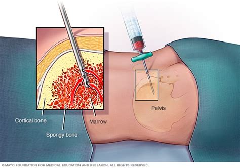 Check spelling or type a new query. Bone marrow biopsy - Mayo Clinic