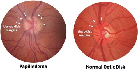 papilledema  normal optic disc blurred  sharp
