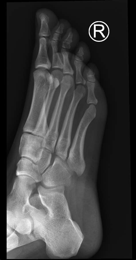 Normal Foot X Rays Image