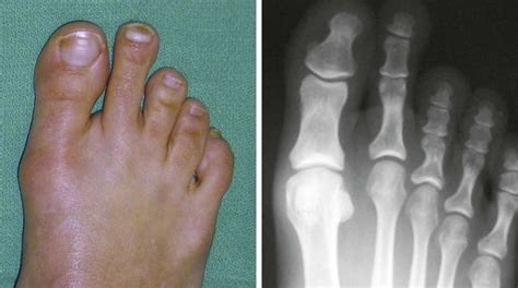 Lesser Toe Deformities Musculoskeletal Key