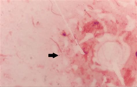 Gram Stain Of Synovial Fluid With Visible Gramnegative Diplococci