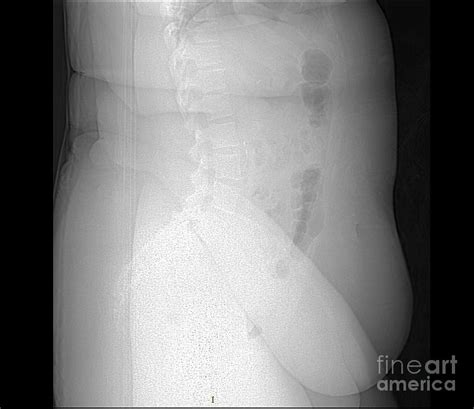 X Ray Of Morbidly Obese Patient Photograph By Living Art Enterprises