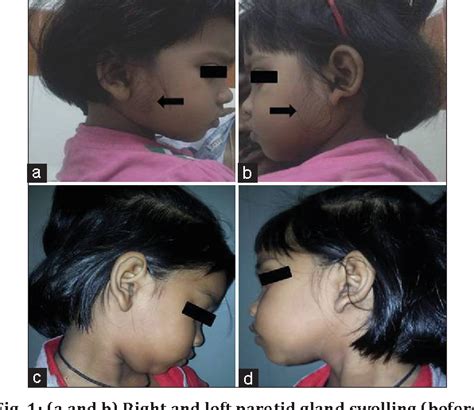 Figure 1 From Of Tuberculosis In Parotid Gland Found In Children At A