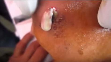 Pimple popping pimples videos youtube beauty beleza beauty illustration youtube movies. youtube cyst popping cheese | New Pimple Popping Videos