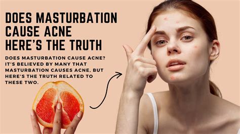 Does Masturbation Cause Acne Heres The Truth Sprint Medical