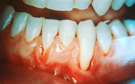 Wat Is Parodontitis En Hoe Kun Je Het Behandelen Tandvleesarts My Xxx