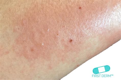 Online Dermatology Itchy Red Rash And Spots On Your Skin What Could They Be