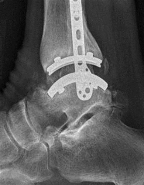Foot And Ankle Implants And Technologies Zimmer Biomet