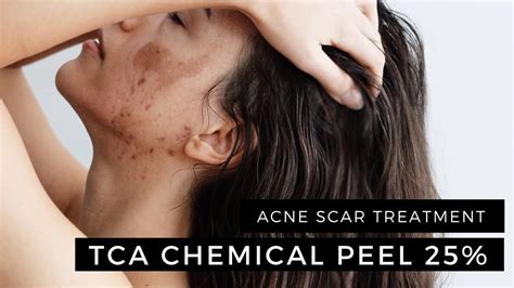 Enerpeel TCA Chemical Peel 25% 2 Layers Acne Scar Treatment - YouTube
