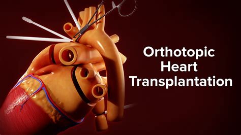 Medical Animation Orthotopic Heart Transplantation Cincinnati