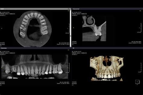 Tomograf A Computarizada Cone Beam En Endodoncia Dicorsa