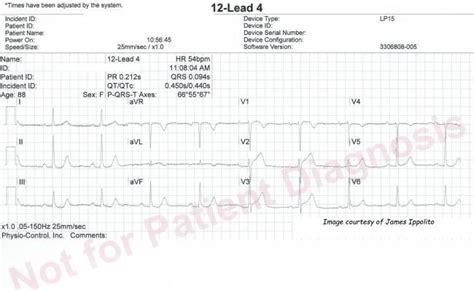 St segment is the flat section of the ecg between end of s and start of the t wave between ventricular depolarization and repolarization ekg. DeWinter T Waves | Emergency medicine, Waves, Emergency